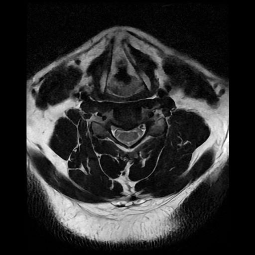 Resonancia magnética de columna cervical, corte axial ponderado en T2.
