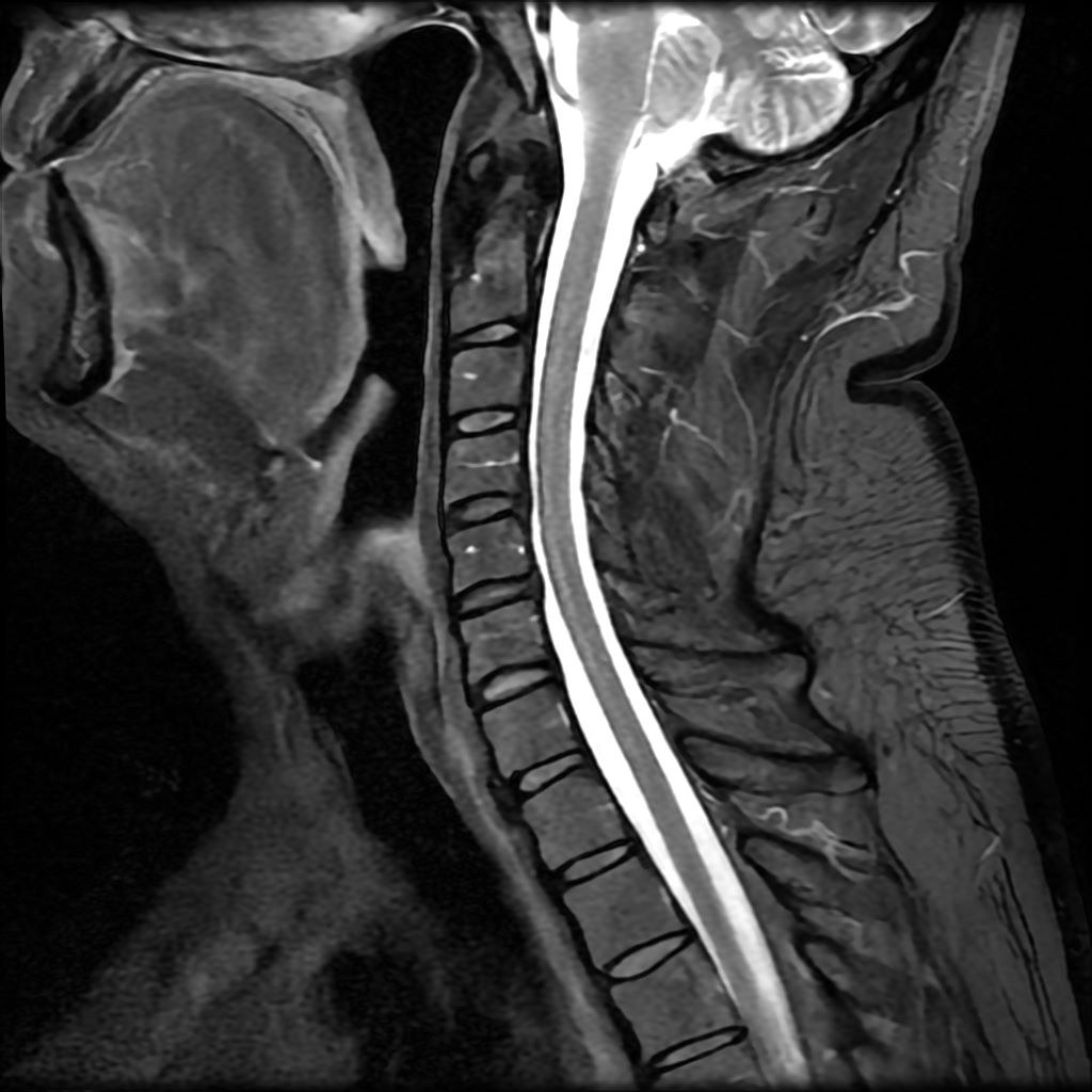 Resonancia magnética de columna cervical, corte sagital con supresión grasa (STIR).