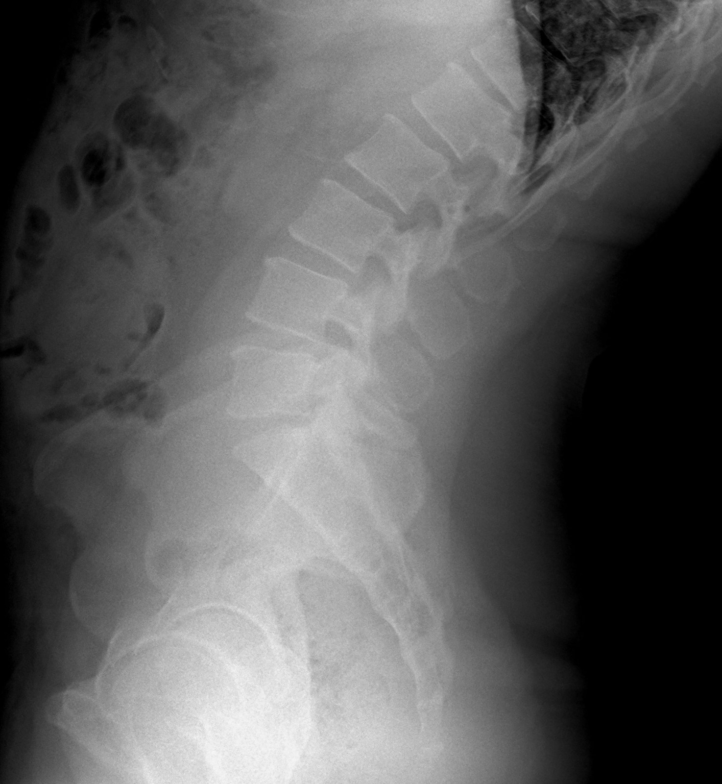 Radiografía dinámica de columna lumbar, proyección lateral en extensión.