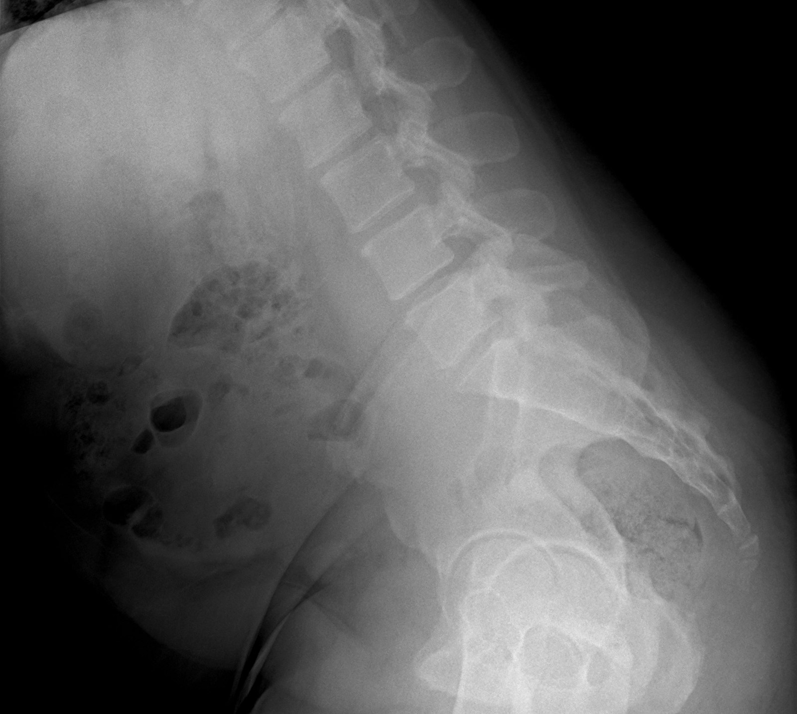 Radiografía dinámica de columna lumbar, proyección lateral en flexión.