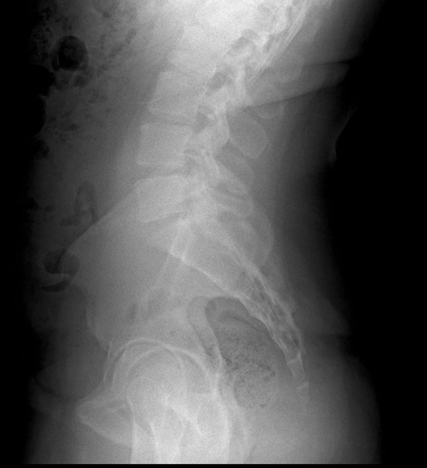 Radiografía de columna lumbar, proyección lateral en posición neutra.